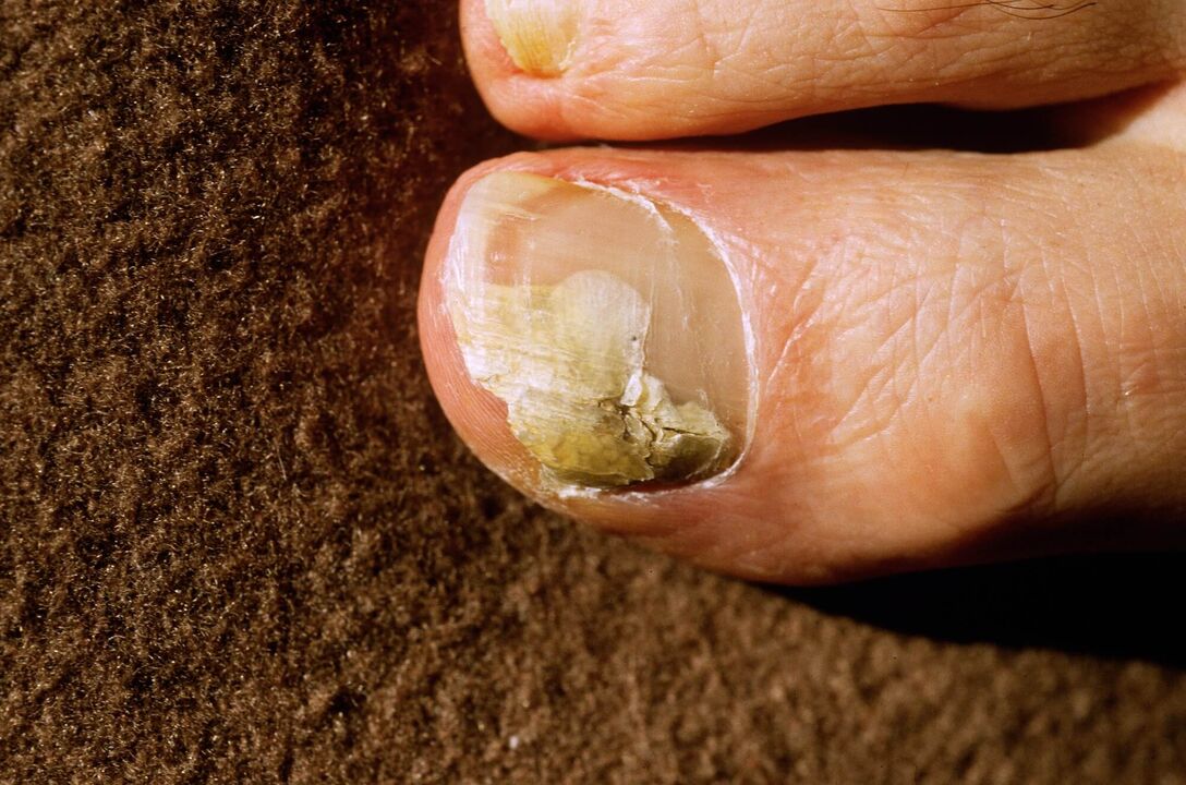 Onyhycosis