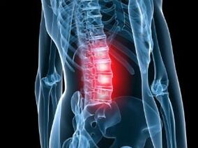 Osteochondrosis of lumbar spine