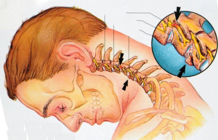 what happens in cervical osteochondrosis