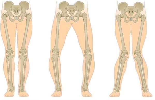 types of arthrosis