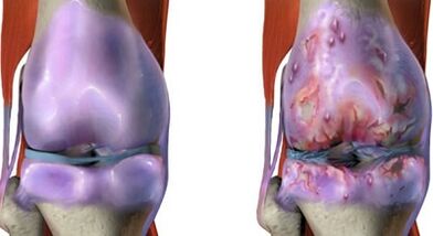 Main differences of arthritis and arthrosis