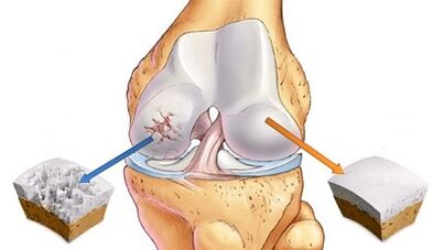 Reasons for developing an arthrosis of joints