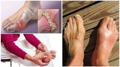 What is an arthritis of the wrist